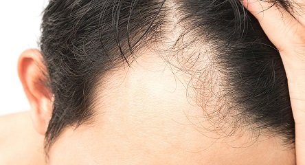 אלופציה פתרון ריביירה שיער