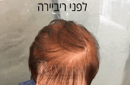 מילוי שיער ריביירה אישה