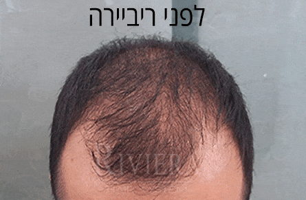 עיבוי שיער ריביירה גבר